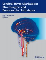 Cerebral Revascularization Microsurgical and Endovascular Techniques